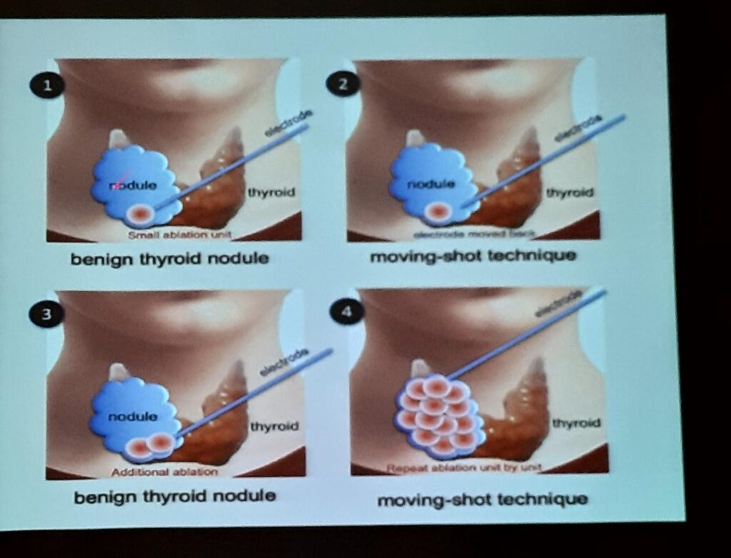 Uklanjanje  čvorova štitne žlijezde i dojke  novom metodom , mikrotalasnom termoablacijom